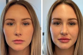 Lip Fillers Injections 4 Lip Fillers Injections in Dubai Before and After