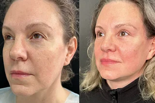 Microneedling in Dubai Before and After