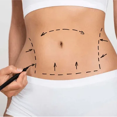 Mini Abdominoplasty