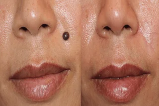 Moles Removal Dubai 4 Moles Removal Dubai before and after