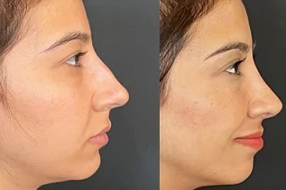 Non Surgical Rhinoplasty in Dubai Before and After