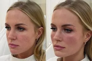 Nose Fillers in Dubai before and after