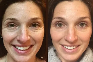 Oxygen Facial 4 Oxygen Facial in Dubai before and after