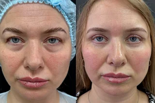 Pico Laser Treatment in Dubai Before and After