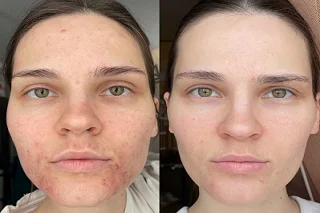 Pimples Treatment 4 Pimples Treatment Before and After