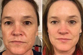 Plasma Pen Treatment 4 Plasma Pen Treatment in Dubai before and after