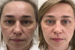 Radiesse Filler Injections 4 Radiesse Filler Injections in Dubai before and after