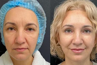 Radio Frequency Treatment in Dubai Before and Before