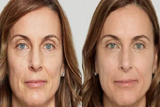 Red Carpet Facial in Dubai 4 Red Carpet Facial in Dubai before and after
