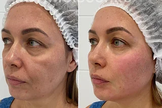 Redermalization Treatment in Dubai Before and After