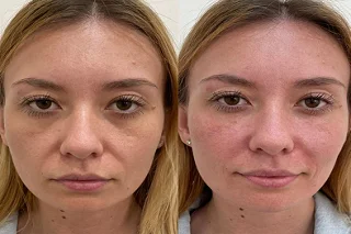 Rejuran Dubai Before and After
