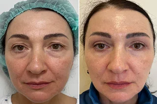 Restylane Fillers in Dubai before and after