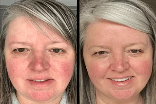 Rosacea Treatment in Dubai Before and After