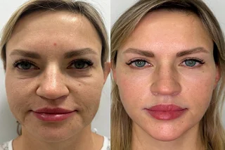 Russian Lips Fillers 4 Russian Lips Fillers in Dubai Before and After