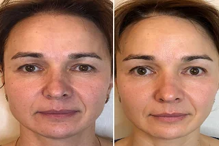 Salmon DNA Injection in Dubai before and after