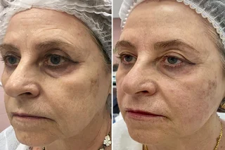 Sculptra Fillers 4 Sculptra Fillers in Dubai before and after