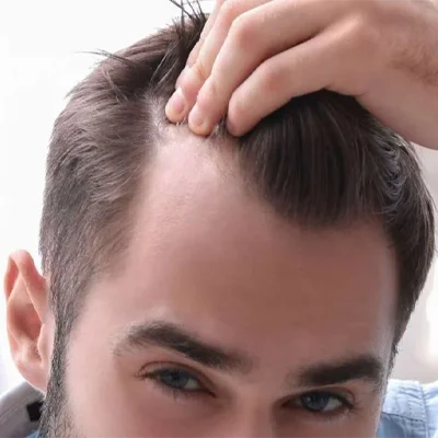Sideburn Hair Transplant