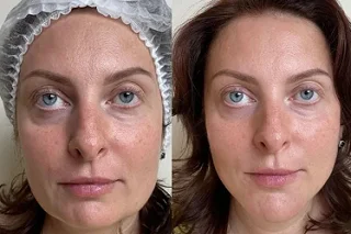 Skin Booster Injections 4 Skin Booster Injections in Dubai before and after