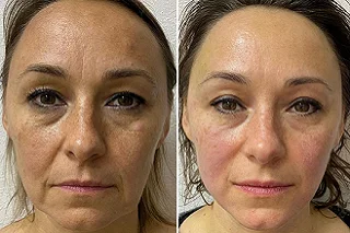 Skin Rejuvenation 4 Skin Rejuvenation in Dubai before and after