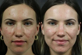 Skin Toning Treatment in Dubai before and after