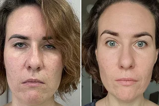 Skin Whitening Treatment in Dubai before and after