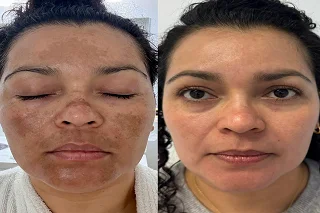 Skincare Treatments 4 Skincare Treatments in Dubai before and after