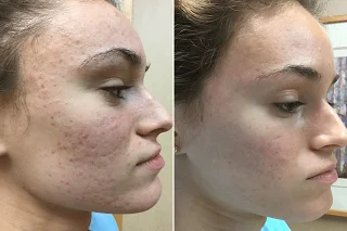 Subcision Treatment for Acne Scars 4 Subcision Treatment for Acne Scars in Dubai before and after