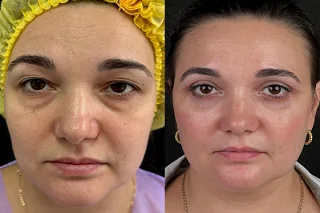 Sunekos Injection in Dubai before and after