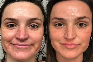 Tan Removal Treatment 4 Tan Removal Treatment in Dubai before and after