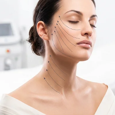 Vector Facelift Treatment