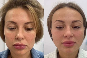 Volbella Filler 4 Volbella Filler in Dubai Before and after