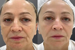Volite Fillers 4 Volite Fillers in Dubai before and after