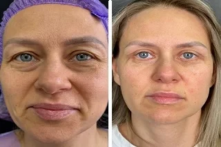 before and after voluma filler