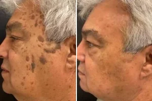 Before and After Seborrheic Keratosis Treatment