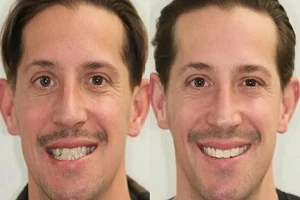 Before and After Teeth Whitening Dubai
