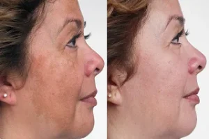 Birthmarks Removal Treatment in Dubai Before and After