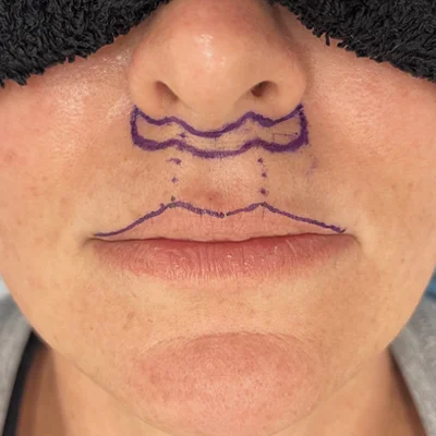 Bullhorn Lip Lift