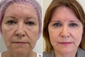 Exosomes Treatment in Dubai before and After