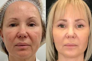 Factor Five Skin Care in Dubai Before and After