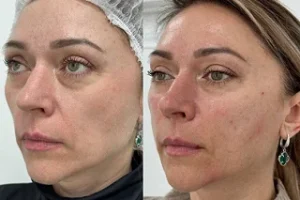 Fine Lines and Wrinkles Removal 4 Fine Lines and Wrinkles Removal in Dubai Before and After