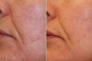 Large Pores Treatment in Dubai Before and After