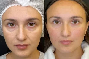 Laser Carbon Peels in Dubai Before and After