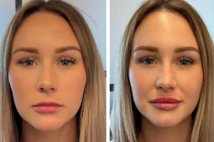 Lip Fillers Injections 4 Lip Fillers Injections in Dubai Before and After