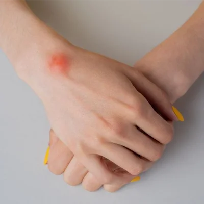 Lipoma Treatment
