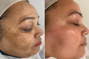 Melasma Treatment Before and After