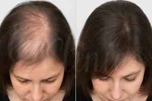 Mesotherapy for Hair in Dubai Before and After
