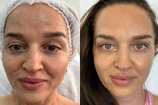 Mesotherapy in Dubai 4 Mesotherapy in Dubai Before and After