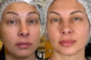 Ultherapy Treatment 4 Ultherapy Treatment in Dubai Before and After