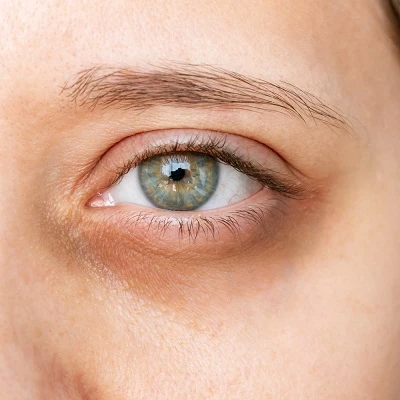 How to Remove Dark Circles Under the Eyes Permanently